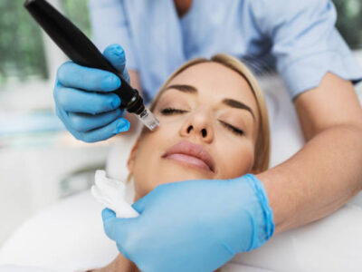 microneedling